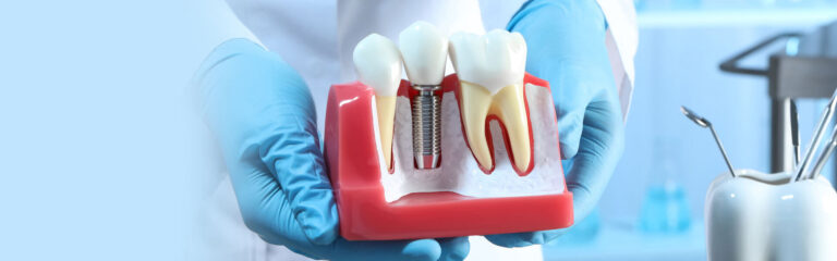 Dental Implants Model
