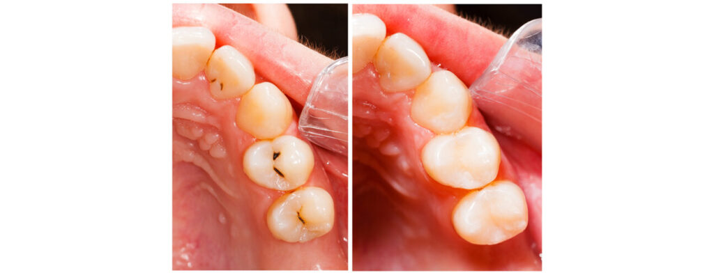 White Dental Fillings in Lakeway, TX